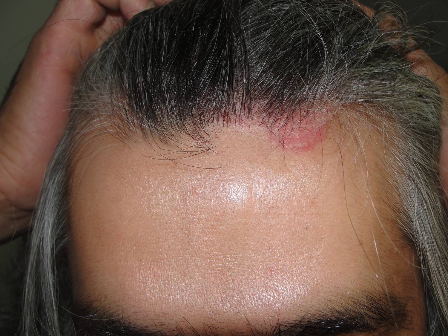 Como distinguir priva la psoriasis